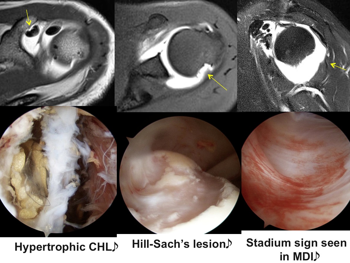 Figure 3 for case MDI and hypertrophy CHL